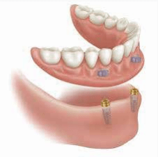 dentalimplants